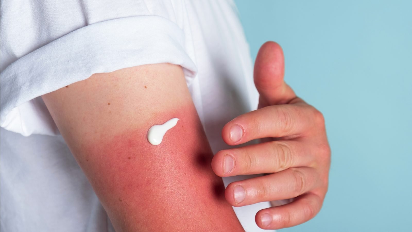 Krem na poparzone miejsca